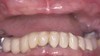 Dentures & Partial Dentures Before & After Image