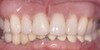 Dentures & Partial Dentures Before & After Image
